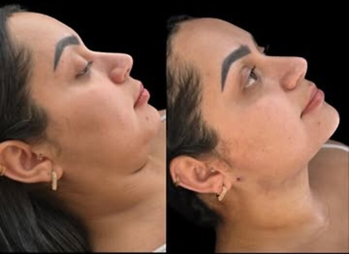 Perfil de paciente antes e depois da Lipo de Papada pelo Método BB